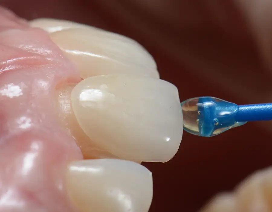 Appllicazioni faccette dentali - Studio dentistico a Brescia – Dott.ssa Irina Garaeva