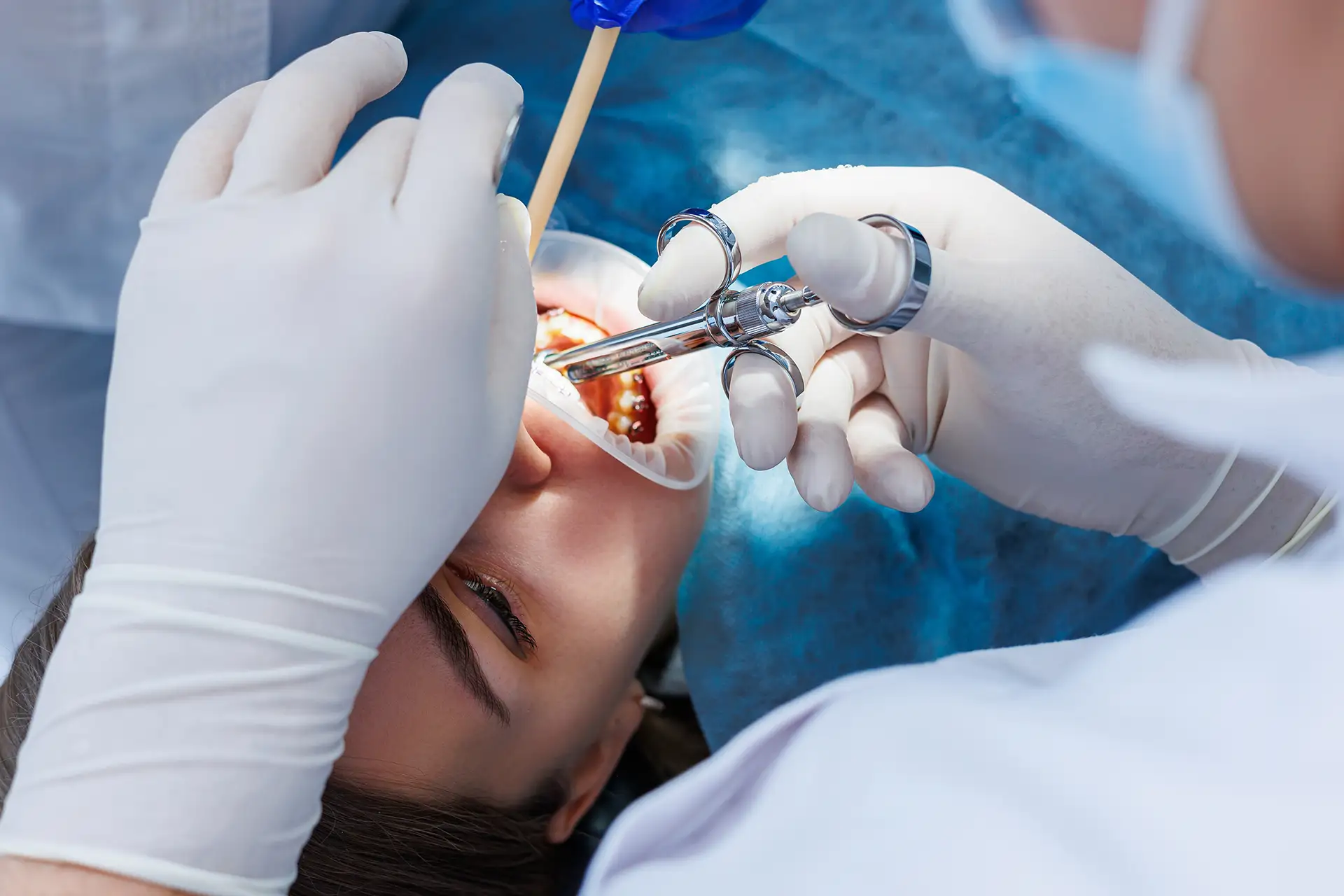 Chirurgia Orale - Studio dentistico a Brescia – Dott.ssa Irina Garaeva