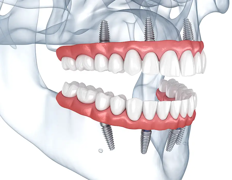 Diagnosi approfondita e tecnologie avanzate per risultati stabili e duraturi - Studio dentistico a Brescia – Dott.ssa Irina Garaeva