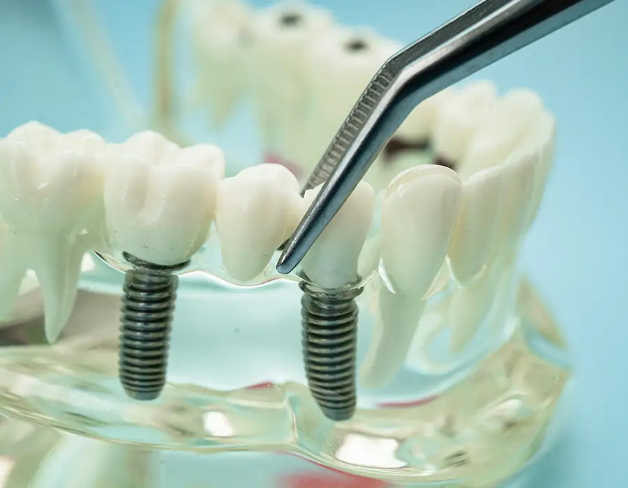 Impianti dentali - Studio dentistico a Brescia – Dott.ssa Irina Garaeva