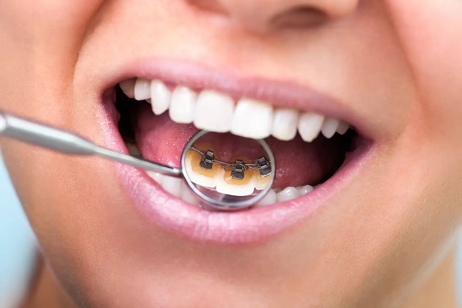 Chirurgia Orale - Studio dentistico a Brescia – Dott.ssa Irina Garaeva