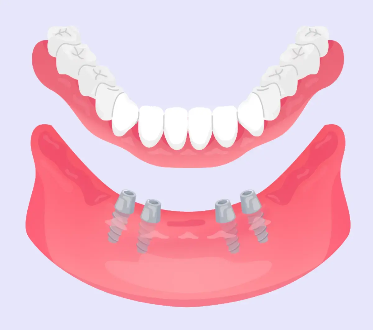 Protesi fissa - Studio dentistico a Brescia – Dott.ssa Irina Garaeva