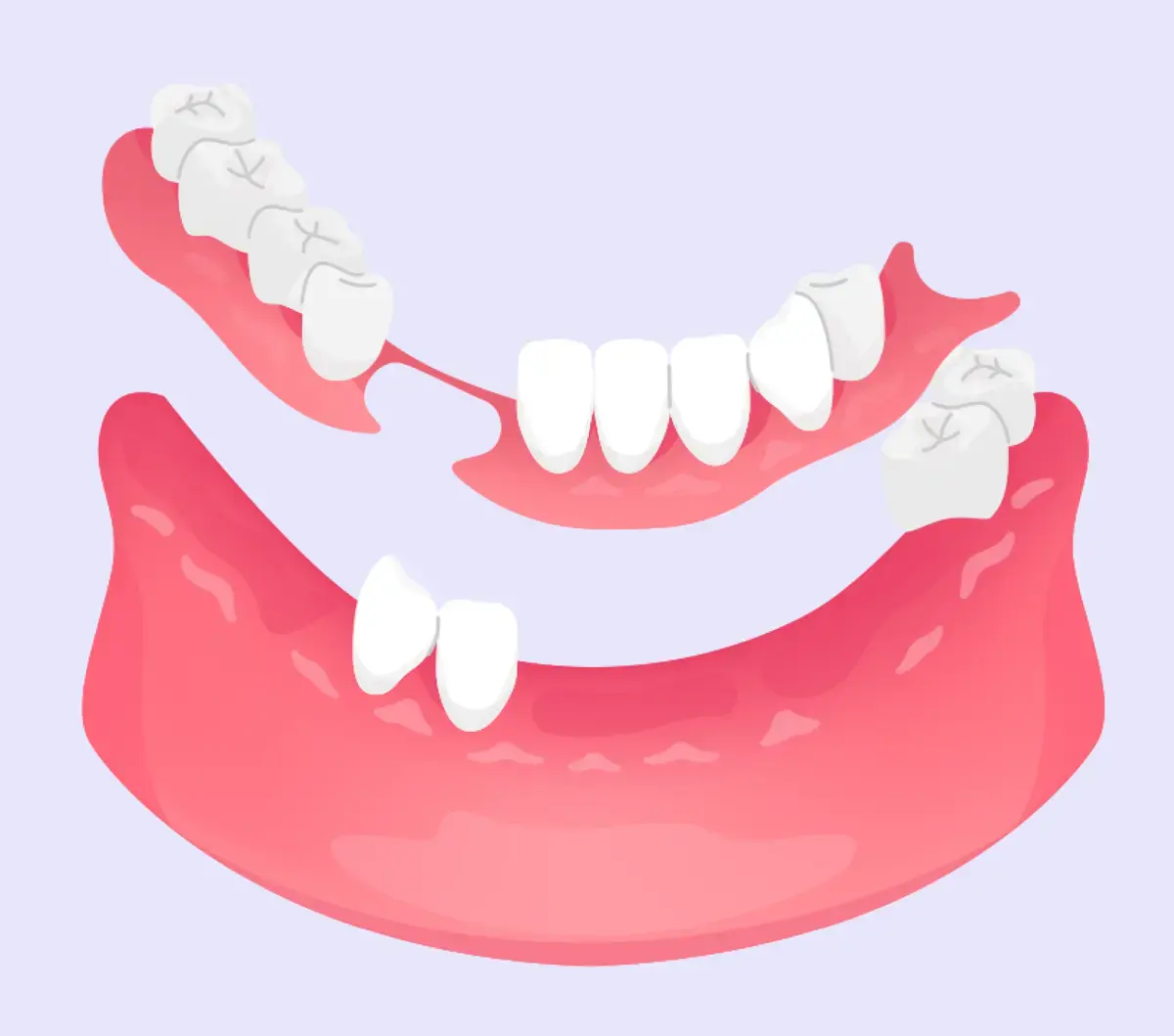Protesi mobile - Studio dentistico a Brescia – Dott.ssa Irina Garaeva