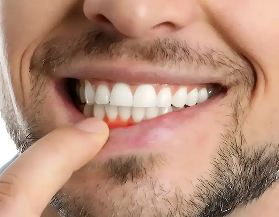 Sintomi parodontite - Studio dentistico a Brescia – Dott.ssa Irina Garaeva