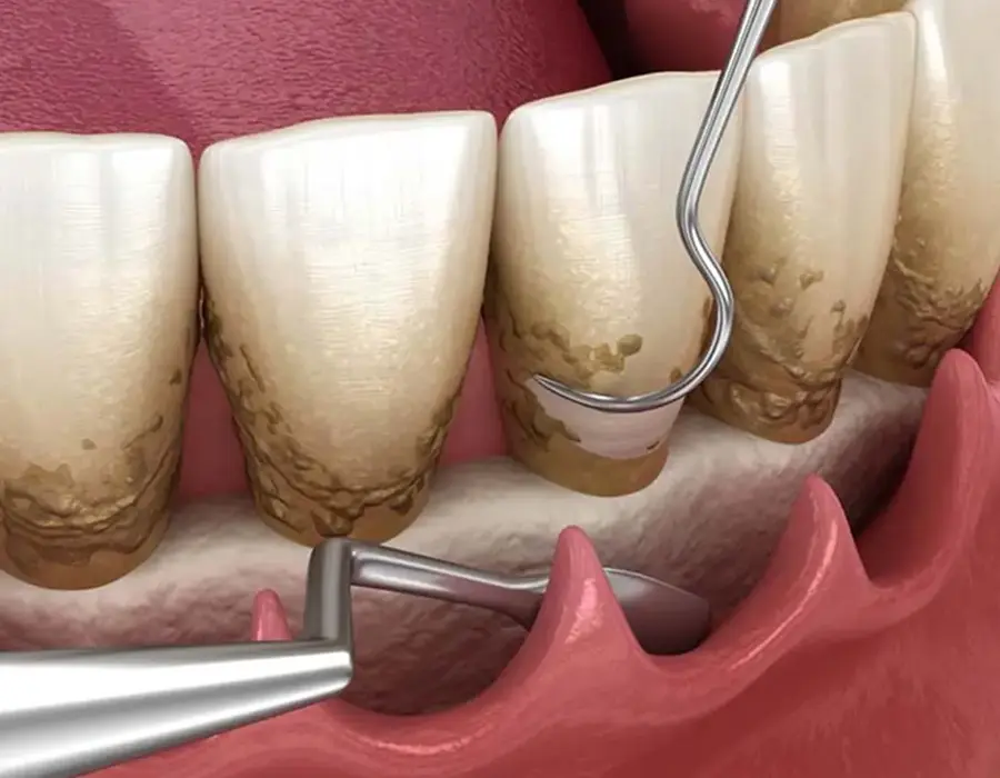 Terapia causale - Studio dentistico a Brescia – Dott.ssa Irina Garaeva
