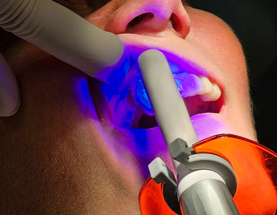 Sbiancamento dentale professionale - Studio dentistico a Brescia – Dott.ssa Irina Garaeva