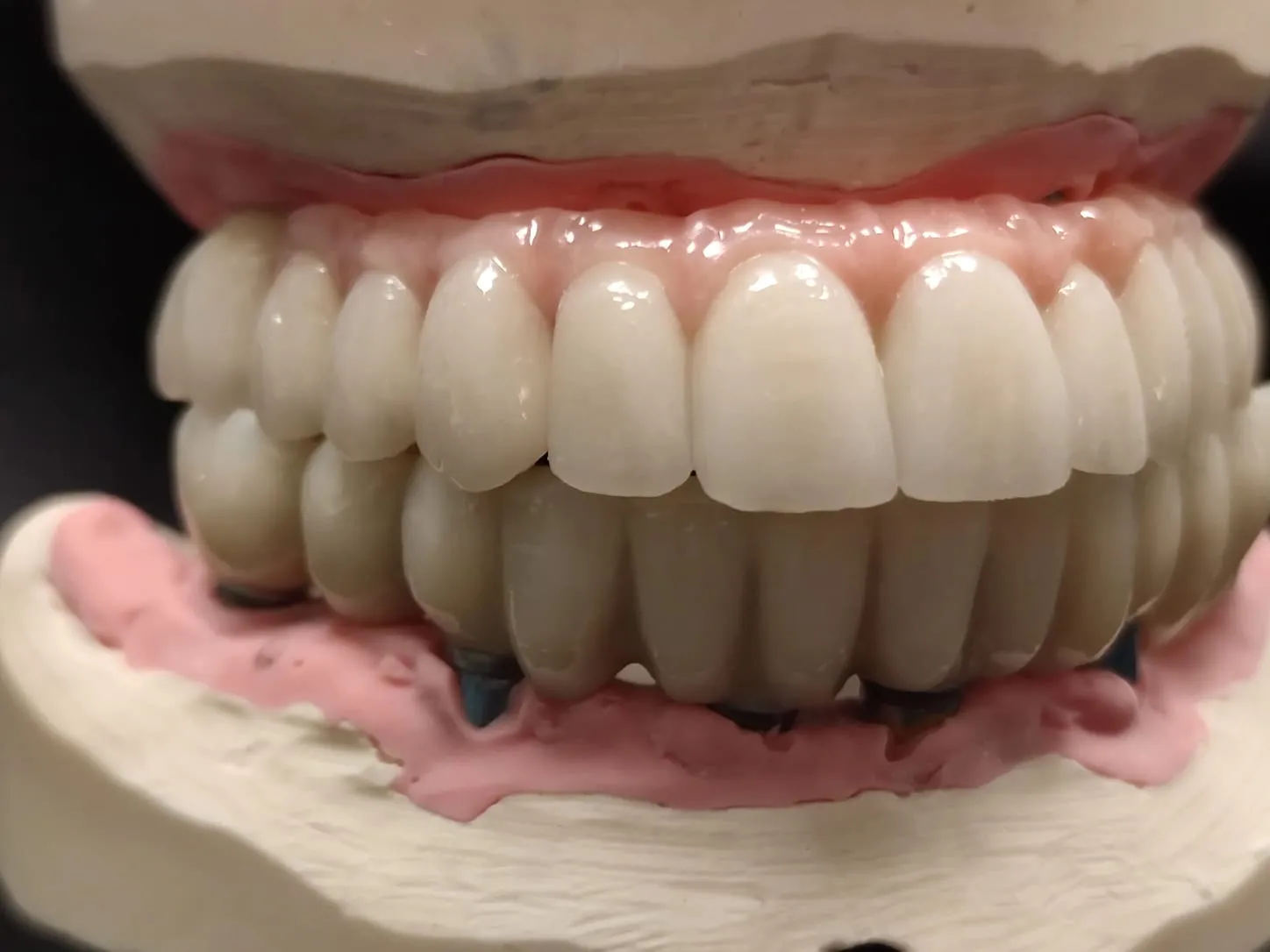 Tecnologie per le faccette dentali - Studio dentistico a Brescia – Dott.ssa Irina Garaeva