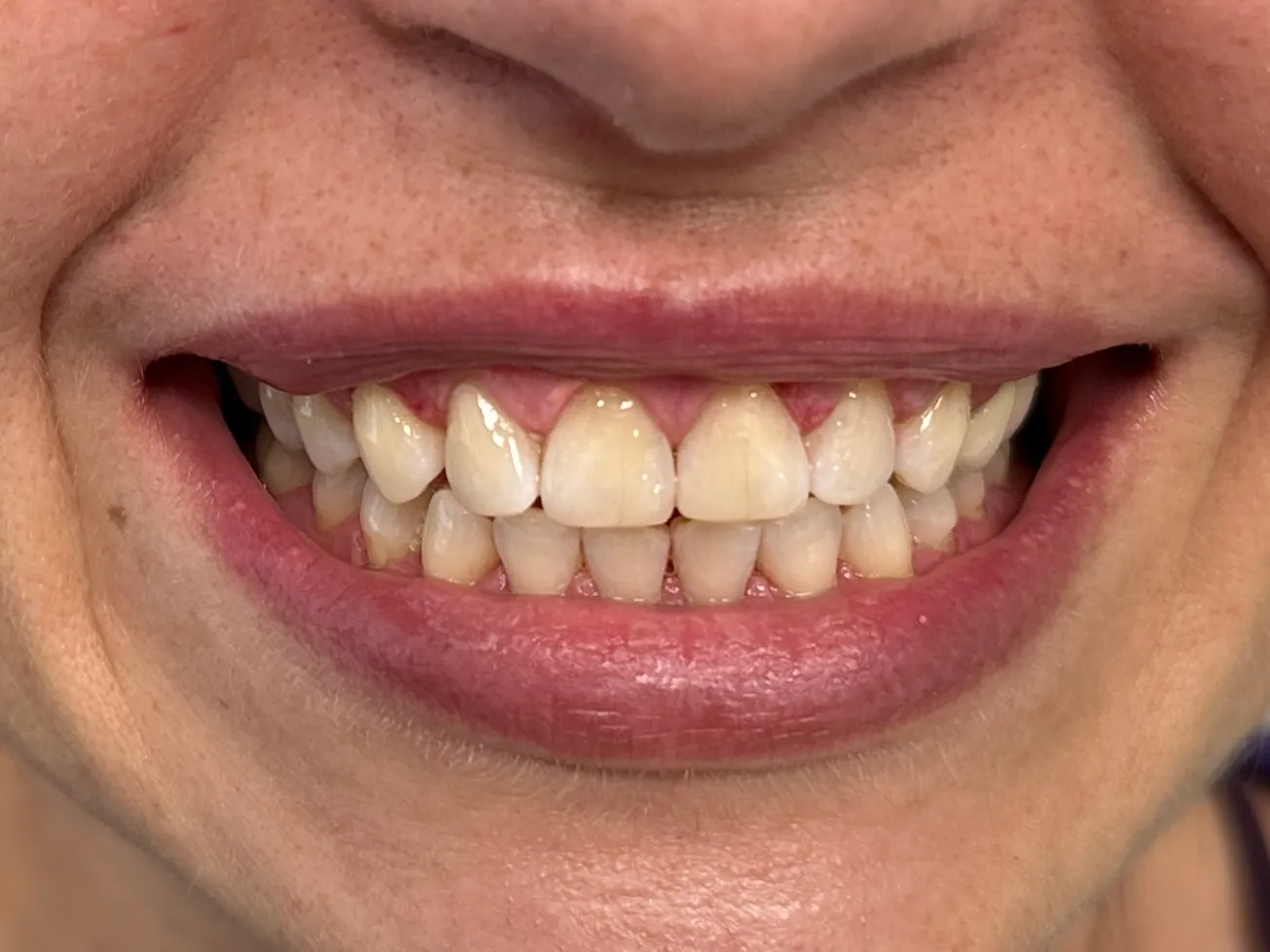 Perché scegliere le faccette dentali - Studio dentistico a Brescia – Dott.ssa Irina Garaeva