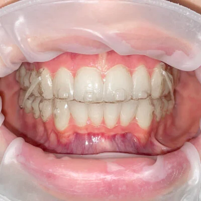 Allineatori invisibili - Scelta consapevole - Studio dentistico a Brescia – Dott.ssa Irina Garaeva