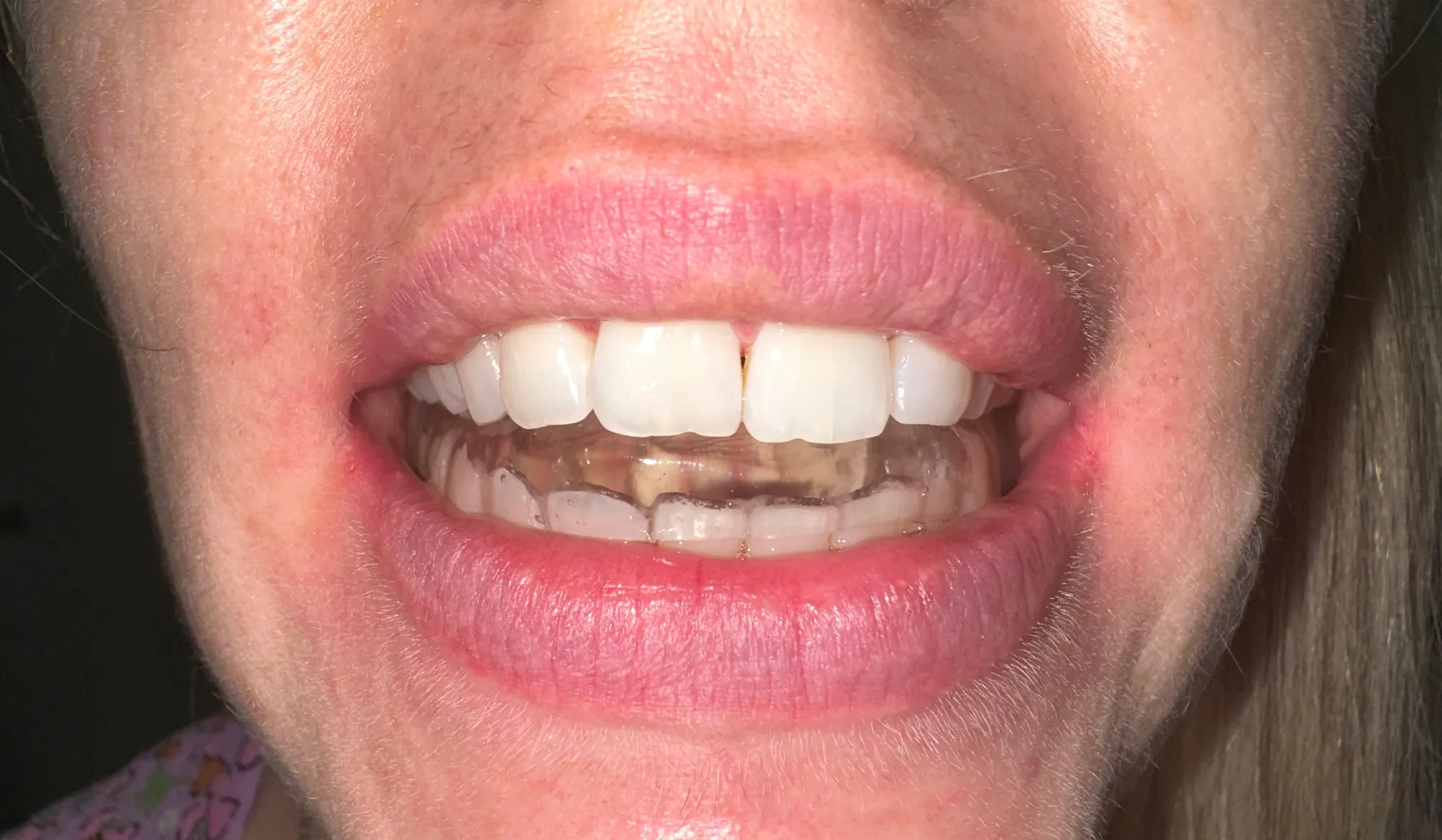 Gnatologia - Studio dentistico a Brescia – Dott.ssa Irina Garaeva